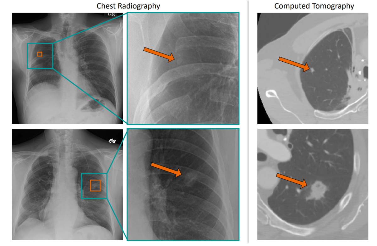 Chest x-rays with markings of suspicious nodules in the lungs