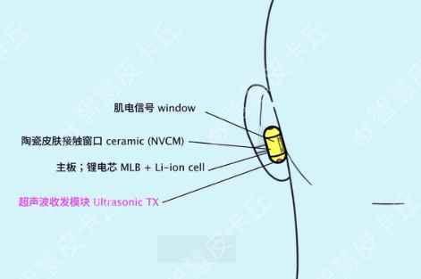 Die Komponenten von "Sweetpea": ein EMG-Signalfenster zur Erkennung von Muskelsignalen, ein Keramik-Hautkontaktfenster, Hauptplatine mit Lithium-Ionen-Akku sowie ein Ultraschall-Sende-/Empfangsmodul. | Bild: via zhihuipikachu